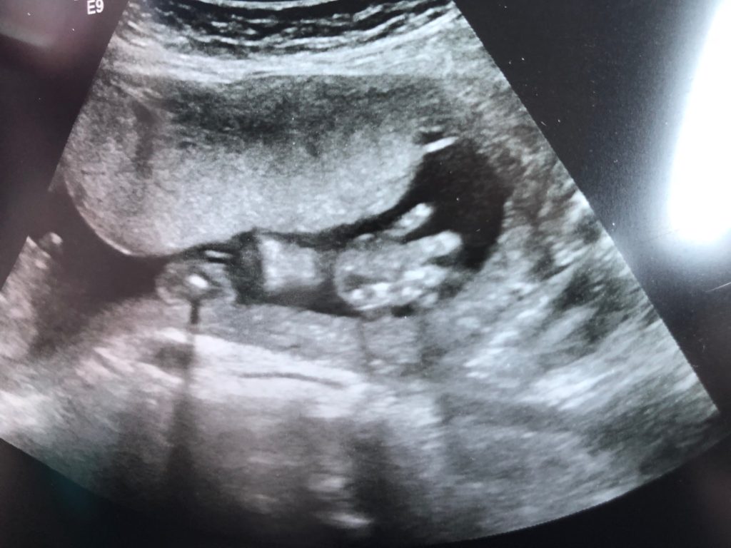 Ultrasound photo- hand waving