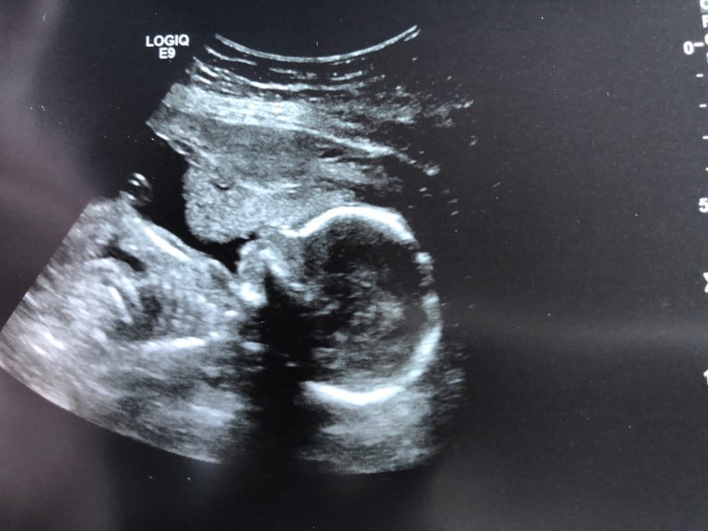 ultrasound photo profile